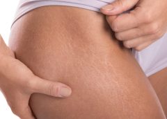 Những biểu hiện của rạn da và nguyên nhân là gì?